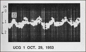 thumb he first echocardiogram made by Inge Edler and Hellmuth Hertz in 1953