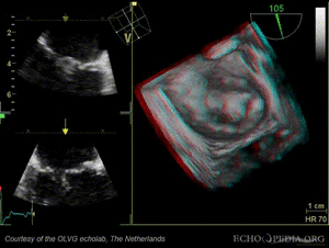 3D MV chordaruptuur.gif