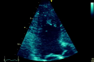 Apical Hypertrphy 2.gif