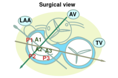 MV surgical view.svg