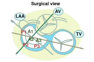 MV surgical view.svg