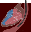 Transesophageal echocardiography diagram.svg