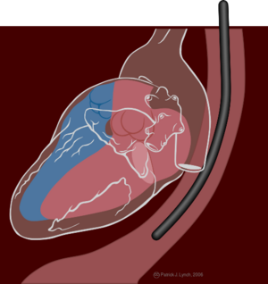 Transesophageal echocardiography diagram.svg