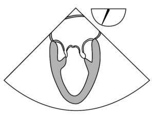 ME mitral commissural.svg