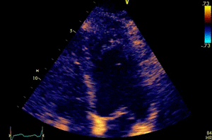 Apical Hypertrphy.gif