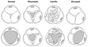 Aortic valve pathology.svg